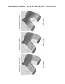 Patient-Adapted and Improved Articular Implants, Designs and Related Guide     Tools diagram and image