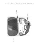 Patient-Adapted and Improved Articular Implants, Designs and Related Guide     Tools diagram and image