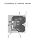 Patient-Adapted and Improved Articular Implants, Designs and Related Guide     Tools diagram and image