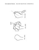 Patient-Adapted and Improved Articular Implants, Designs and Related Guide     Tools diagram and image