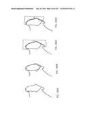 Patient-Adapted and Improved Articular Implants, Designs and Related Guide     Tools diagram and image