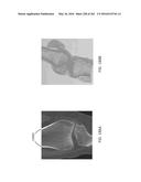 Patient-Adapted and Improved Articular Implants, Designs and Related Guide     Tools diagram and image