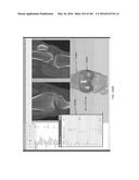 Patient-Adapted and Improved Articular Implants, Designs and Related Guide     Tools diagram and image