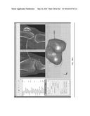 Patient-Adapted and Improved Articular Implants, Designs and Related Guide     Tools diagram and image