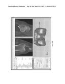 Patient-Adapted and Improved Articular Implants, Designs and Related Guide     Tools diagram and image