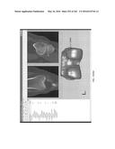 Patient-Adapted and Improved Articular Implants, Designs and Related Guide     Tools diagram and image