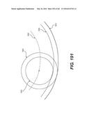 Patient-Adapted and Improved Articular Implants, Designs and Related Guide     Tools diagram and image