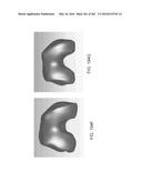 Patient-Adapted and Improved Articular Implants, Designs and Related Guide     Tools diagram and image