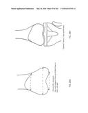 Patient-Adapted and Improved Articular Implants, Designs and Related Guide     Tools diagram and image