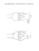 Patient-Adapted and Improved Articular Implants, Designs and Related Guide     Tools diagram and image