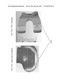 Patient-Adapted and Improved Articular Implants, Designs and Related Guide     Tools diagram and image