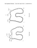 Patient-Adapted and Improved Articular Implants, Designs and Related Guide     Tools diagram and image