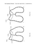 Patient-Adapted and Improved Articular Implants, Designs and Related Guide     Tools diagram and image