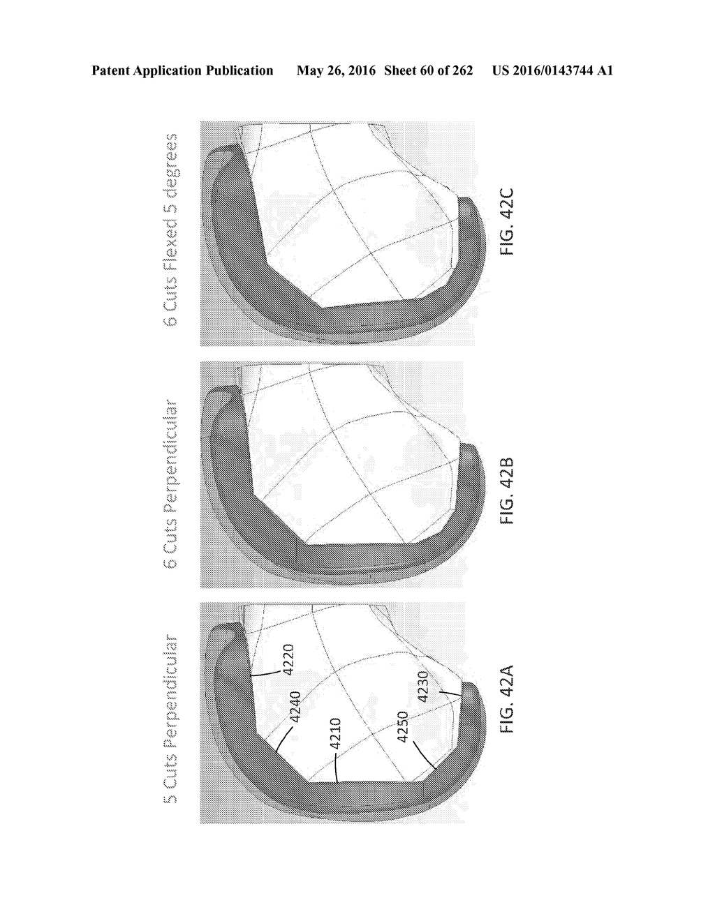 Patient-Adapted and Improved Articular Implants, Designs and Related Guide     Tools - diagram, schematic, and image 61