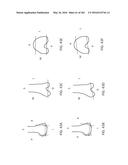 Patient-Adapted and Improved Articular Implants, Designs and Related Guide     Tools diagram and image