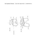 Patient-Adapted and Improved Articular Implants, Designs and Related Guide     Tools diagram and image