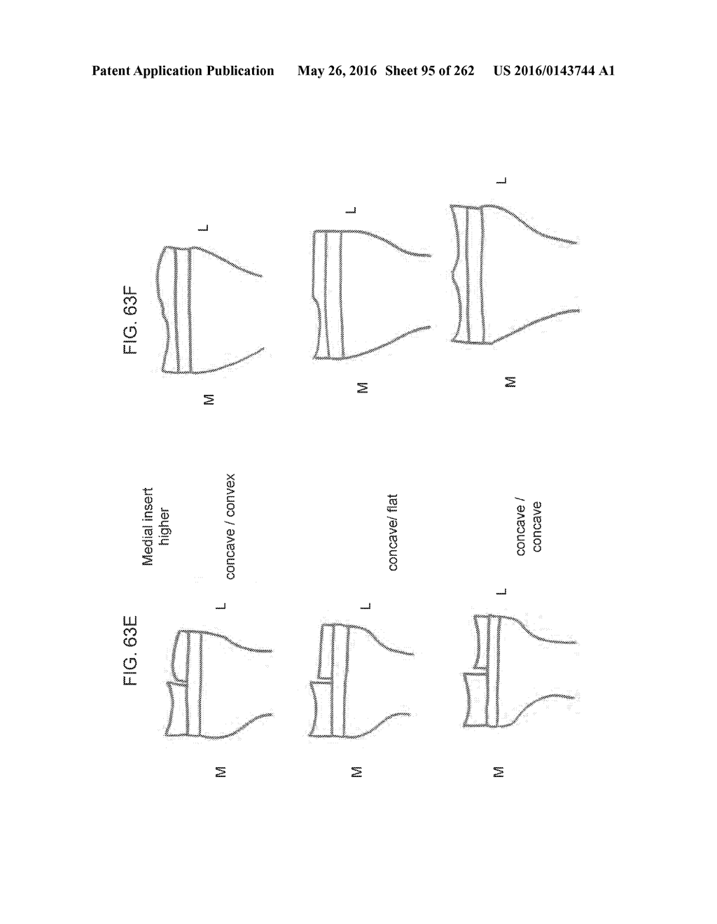 Patient-Adapted and Improved Articular Implants, Designs and Related Guide     Tools - diagram, schematic, and image 96