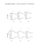 Patient-Adapted and Improved Articular Implants, Designs and Related Guide     Tools diagram and image