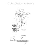 TRANSATRIAL PATIENT TEMPERATURE CONTROL CATHETER diagram and image