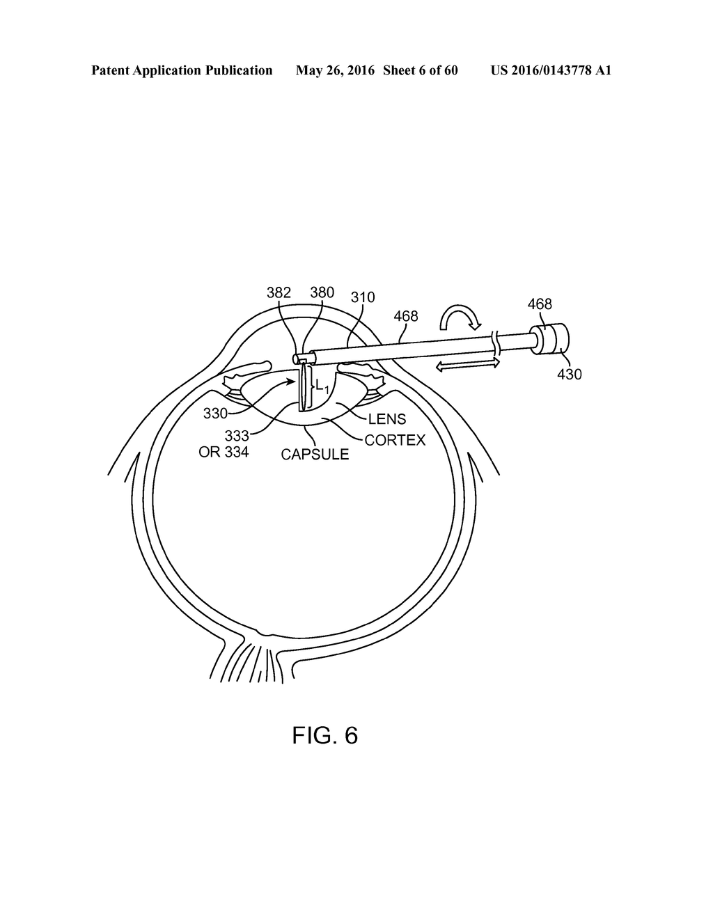 AQUABLATION AQUABEAM EYE SURGERY METHODS AND APPARATUS - diagram, schematic, and image 07