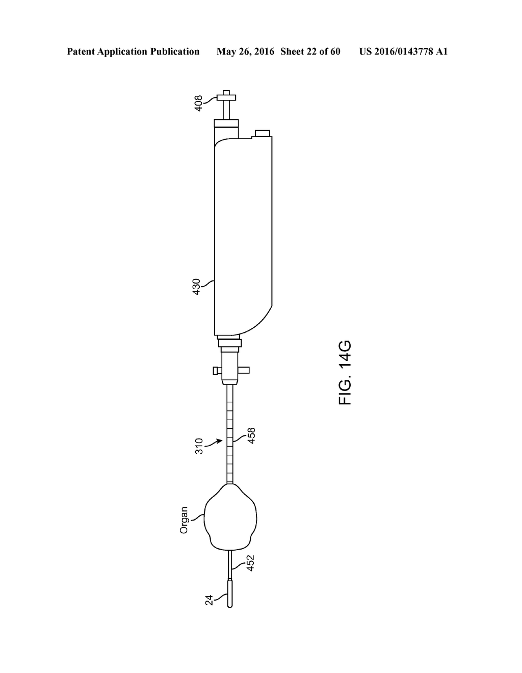 AQUABLATION AQUABEAM EYE SURGERY METHODS AND APPARATUS - diagram, schematic, and image 23