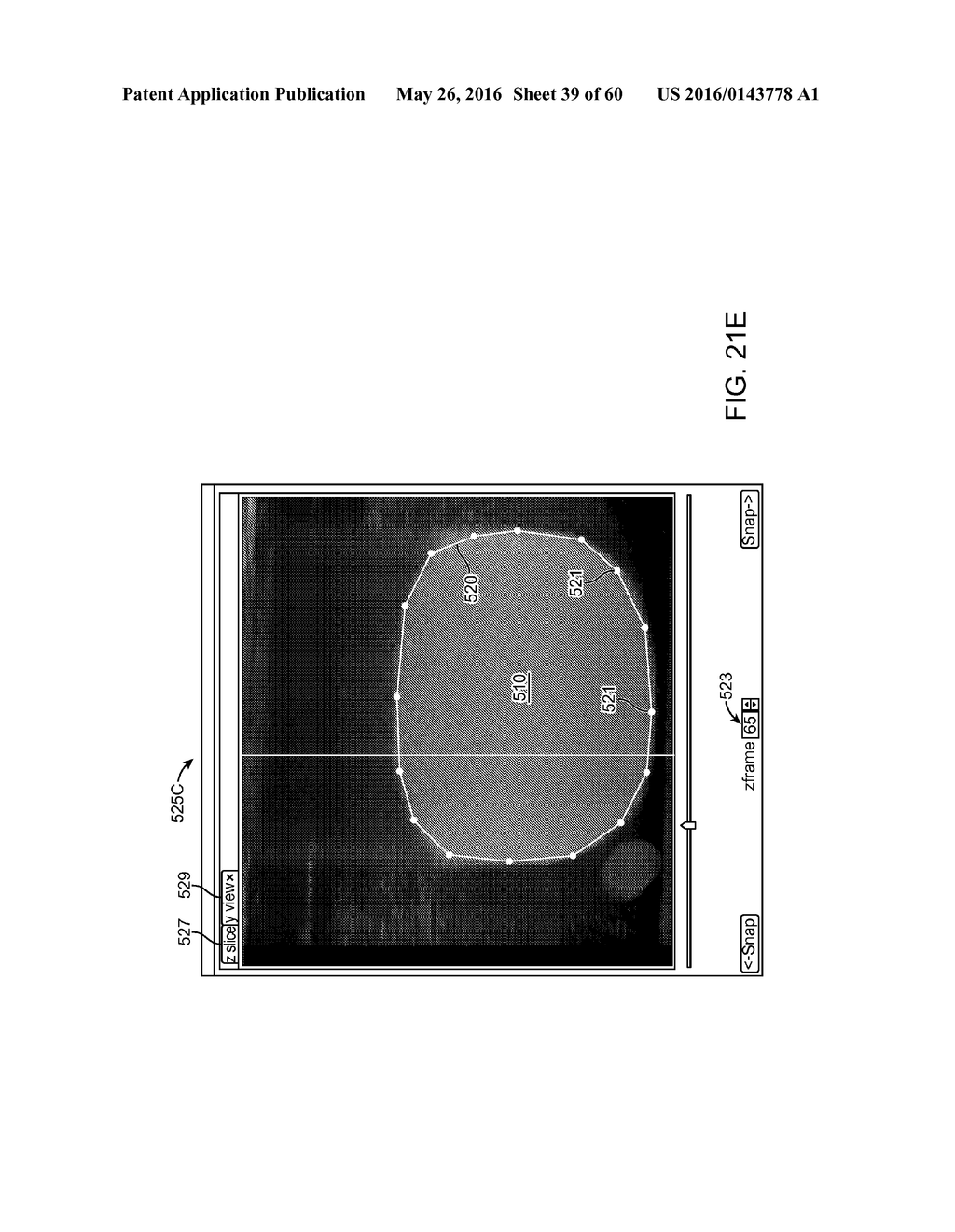 AQUABLATION AQUABEAM EYE SURGERY METHODS AND APPARATUS - diagram, schematic, and image 40