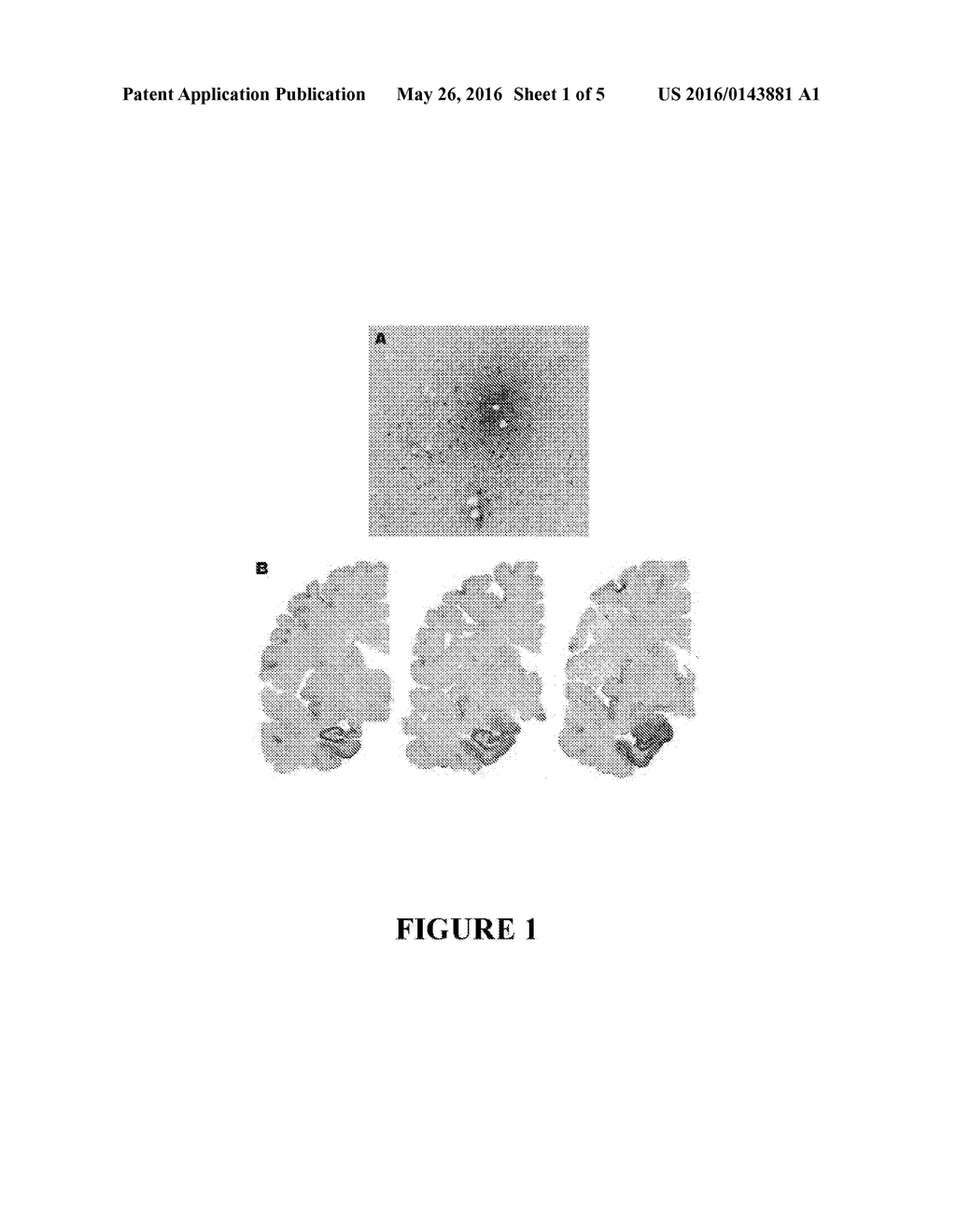 METHOD FOR PREVENTING AND/OR TREATING CHRONIC TRAUMATIC ENCEPHALOPATHY-I - diagram, schematic, and image 02