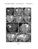 DELIVERY OF A THERAPEUTIC AGENT TO THE CEREBRAL CORTEX BY ADMINISTERING A     VIRAL VECTOR BY CONVECTION ENHANCED DIFFUSION INTO THE WHITE MATTER OF     THE BRAIN diagram and image