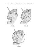 DELIVERY OF A THERAPEUTIC AGENT TO THE CEREBRAL CORTEX BY ADMINISTERING A     VIRAL VECTOR BY CONVECTION ENHANCED DIFFUSION INTO THE WHITE MATTER OF     THE BRAIN diagram and image