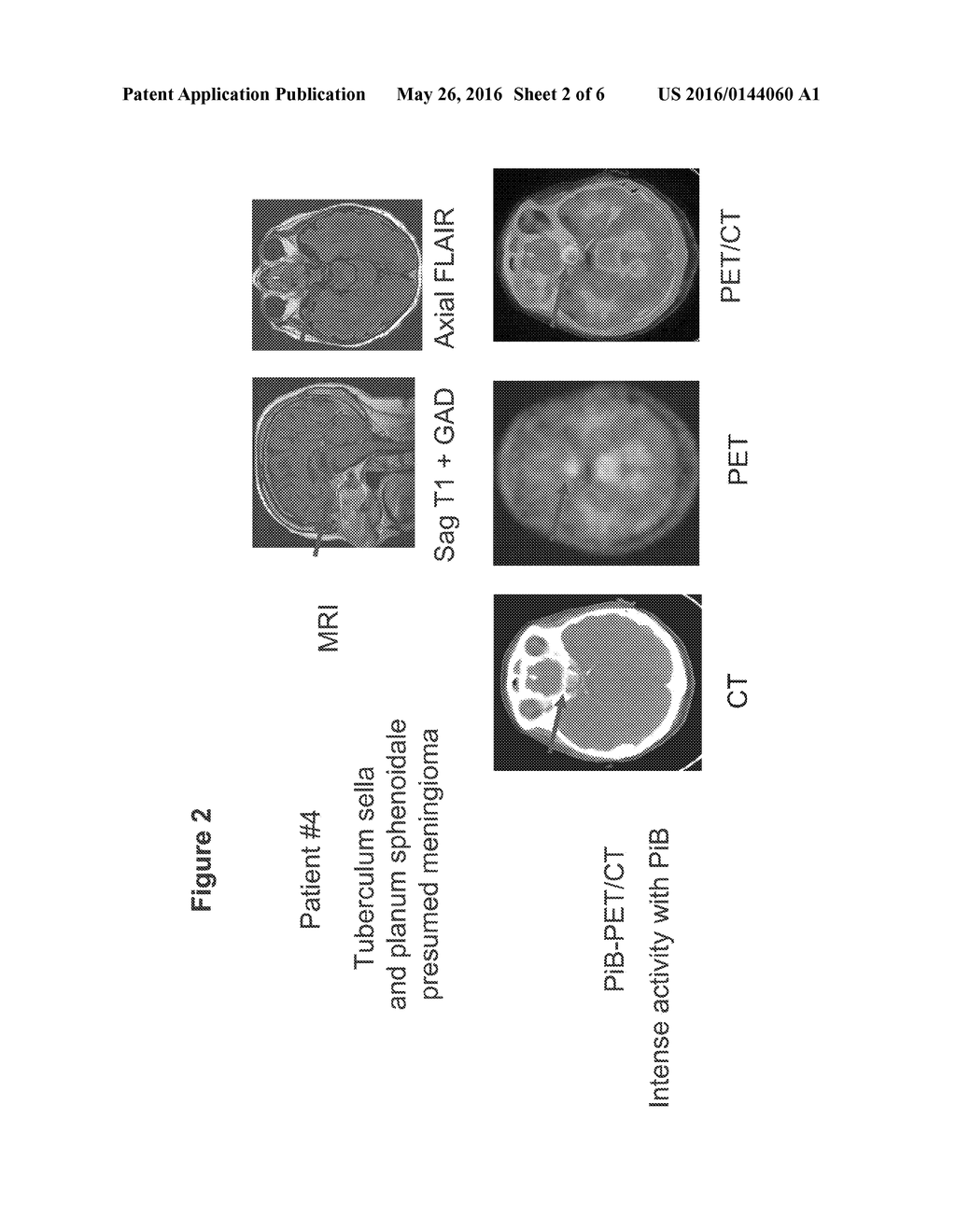 Imaging of Meningiomas Using Phenylbenzothiazole, Stilbene, or     Biphenylalkyne Derivatives - diagram, schematic, and image 03