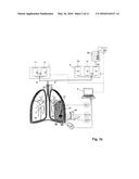 ARRANGEMENT AND METHOD FOR THE IN-VITRO and IN-VIVO TREATMENT OF BRONCHIAL     TUMORS diagram and image