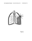 ARRANGEMENT AND METHOD FOR THE IN-VITRO and IN-VIVO TREATMENT OF BRONCHIAL     TUMORS diagram and image