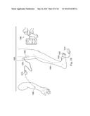 NEUROSTIMULATOR CONFIGURED TO SENSE EVOKED POTENTIALS IN PERIPHERAL NERVES diagram and image