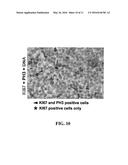 COMPOSITIONS AND METHODS FOR PROGNOSIS AND TREATMENT OF CANCER diagram and image