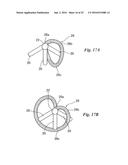 BODY CAVITY FOREIGN MATTER CAPTURE INSTRUMENT diagram and image