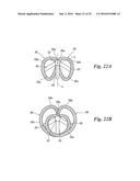 BODY CAVITY FOREIGN MATTER CAPTURE INSTRUMENT diagram and image