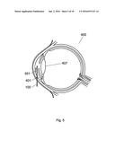 Apparatus For The Treatment of Cataract diagram and image