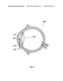 Apparatus For The Treatment of Cataract diagram and image