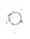 Apparatus For The Treatment of Cataract diagram and image