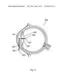 Apparatus For The Treatment of Cataract diagram and image