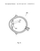 Apparatus For The Treatment of Cataract diagram and image