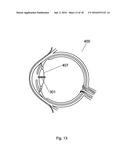 Apparatus For The Treatment of Cataract diagram and image