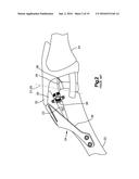 Implants/Procedures Related to Tibial Tuberosity Advancement diagram and image