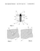 Orthopaedic Cast Tacks diagram and image