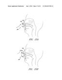 PATIENT INTERFACE AND ASPECTS THEREOF diagram and image