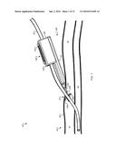 SYSTEM FOR ANCHORING MEDICAL DEVICES diagram and image