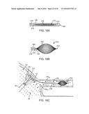 Systems And Methods For Unobstructed Visualization And Ablation diagram and image