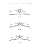 FISTULA TREATMENT DEVICES AND RELATED METHODS diagram and image