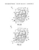 Devices and Methods for Occluding or Promoting Fluid Flow diagram and image