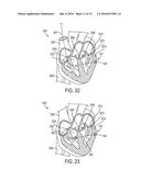 Devices and Methods for Occluding or Promoting Fluid Flow diagram and image